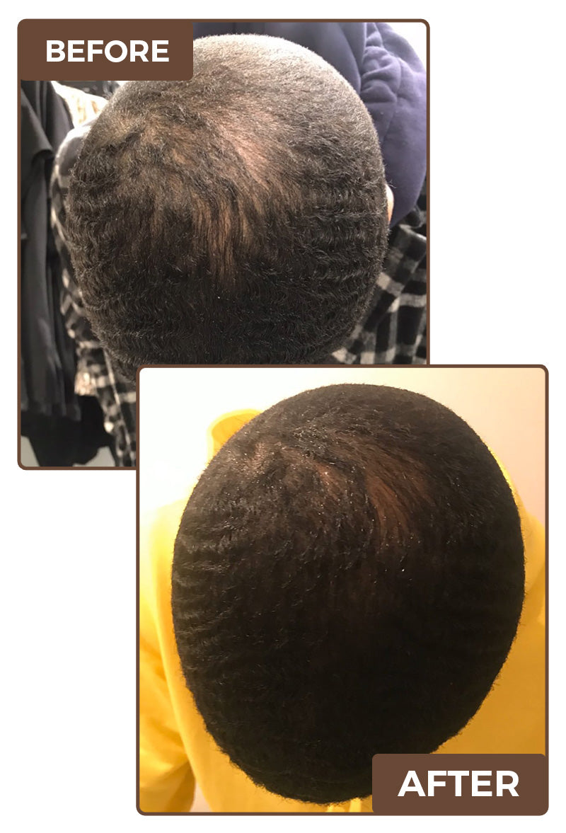 Postpartum Hair Loss Recovery Kit