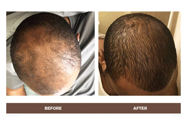 Newsletter: Tackle Hair Loss With Our NEW Bundles