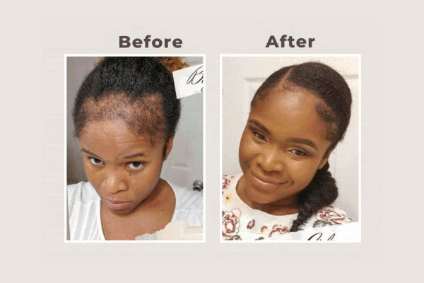 Newsletter: Balding? PostPartum? Chemotherapy? Feel Supported! 💪