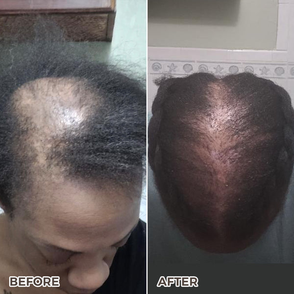 Kreyol Essence postpartum hair loss recovery kit for new moms, featuring scalp and hair health products for natural hair care.