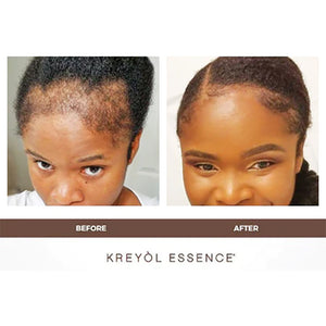 Kreyòl Essence "Save My Hairline" growth treatment duo in a gift set, featuring hair care products for hairline strengthening and growth.