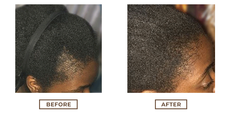 Before and after photos of a customer's hairline