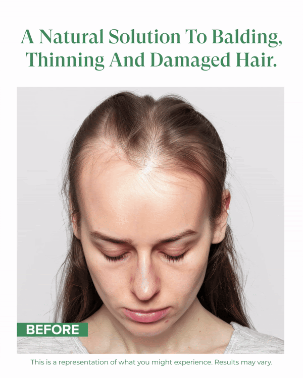 Kreyol Essence postpartum hair loss recovery kit focusing on scalp and hair health for new moms, featuring hairline treatment.