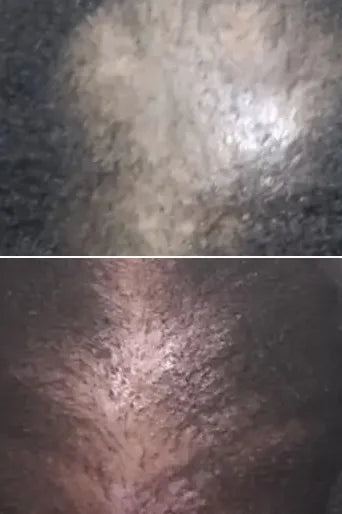 Before and after: crown at day 90
