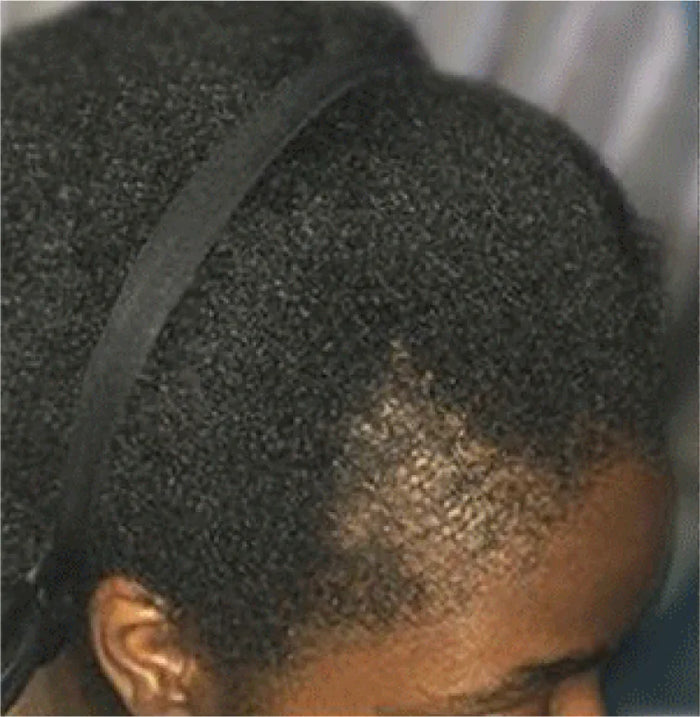 Thinning hair at the crown before using the Kreyol Essence bundle