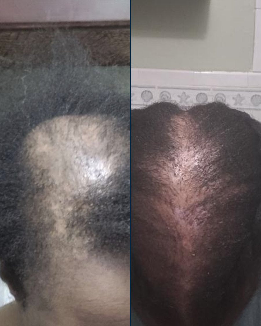 Customer before and after: Day 0 and Day 90 with Haitian Black Castor Oil