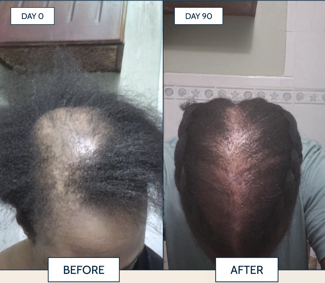 Day 0 to Day 90: customer before and after using Haitian Black Castor Oil